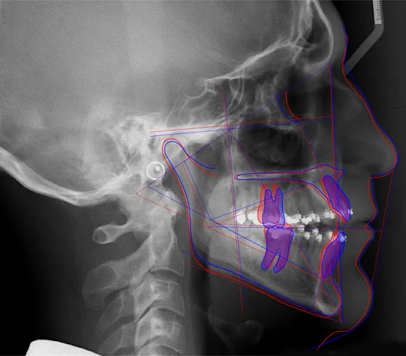 Radiographie céphalométrique orthodontie