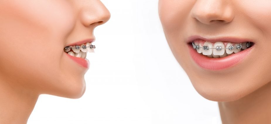 Vue d'ensemble d'un traitement orthodontique fixe multi-attaches sur arcade supérieure
