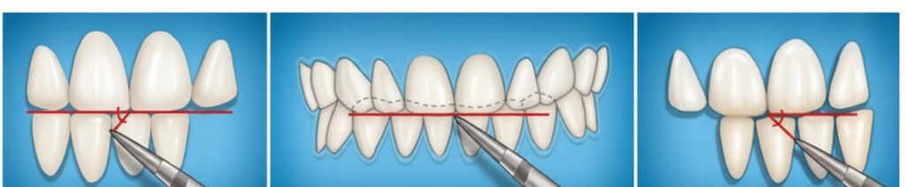 Le Syndrome de Mastication Unilatérale Dominante