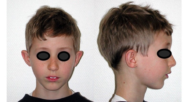 Visage faciès adénoïdien