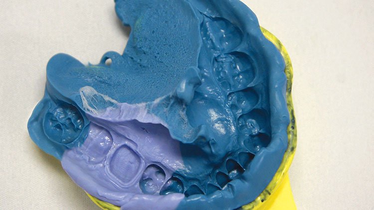 Technique double viscosité silicone empreinte dentaire