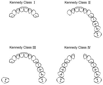 Schéma arcade dentaire édentement partiel vue occlusale