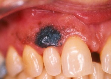 mélanome buccal (lésion hétérogène, palais, bords irréguliers)