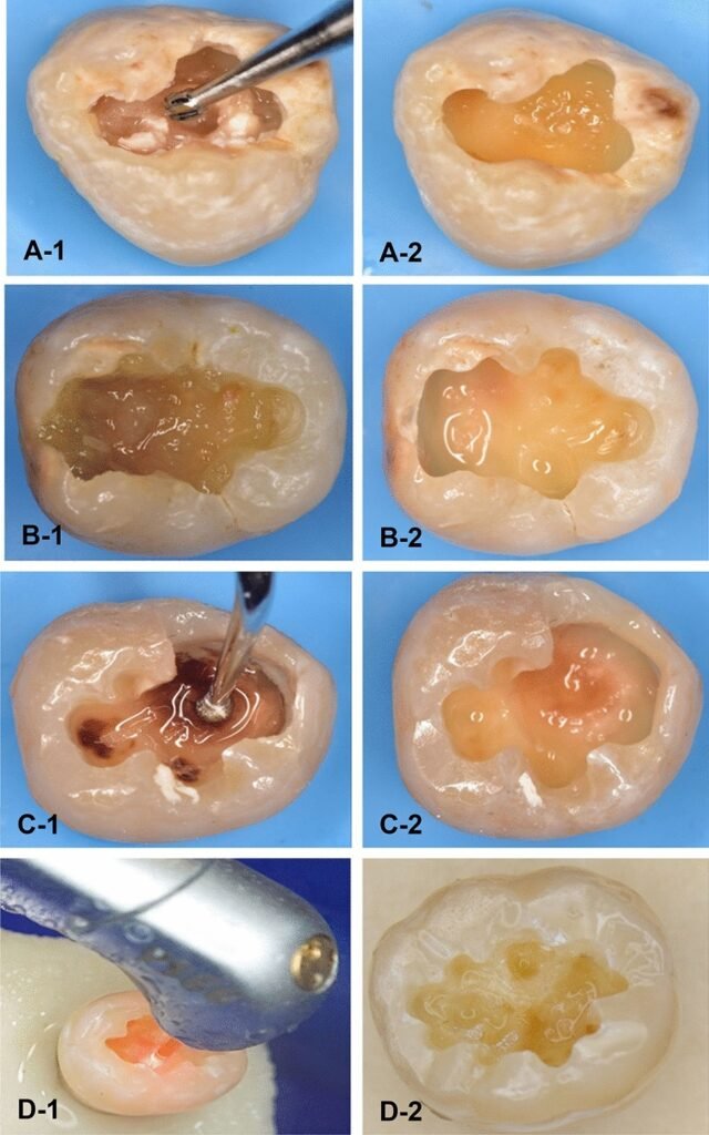 2. Critères cliniques de la dentine

