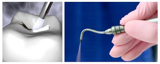 Le Curetage par Air Abrasion