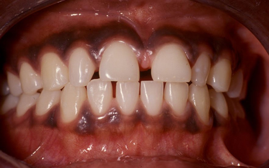 pigmentation physiologique ethnique (gencive attachée brunâtre)