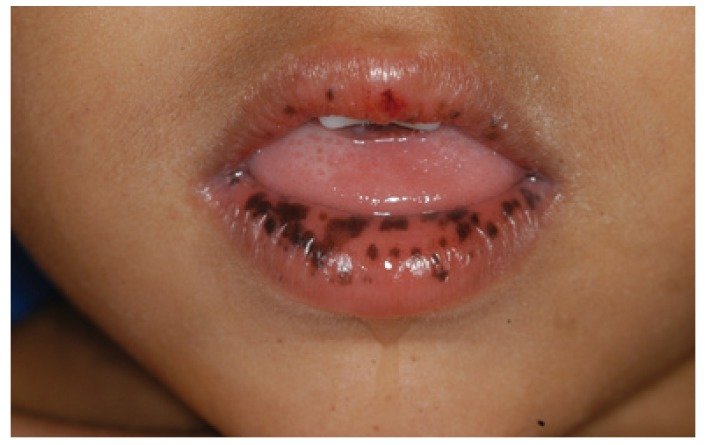 lentigos de Peutz-Jeghers (lèvre inférieure, macules noires péri-orales)