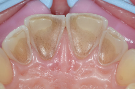 dental erosion upper incisors acid wear clinical photo