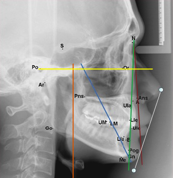  téléradiographie de profil annotée avec points céphalométriques