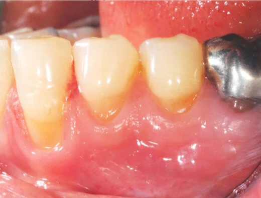 Récession gingivale