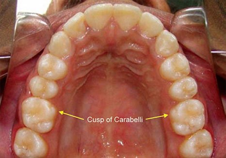 Carabelli cusp upper molar lingual