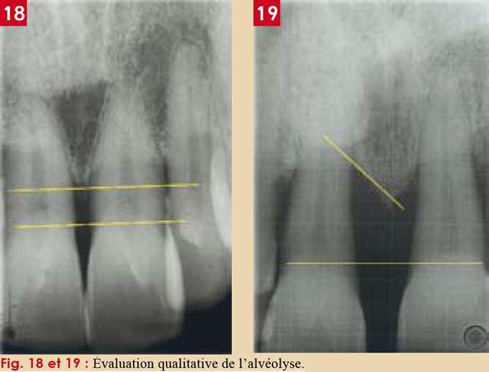 Radiographie d'une poche parodontale avec lyse osseuse angulaibre