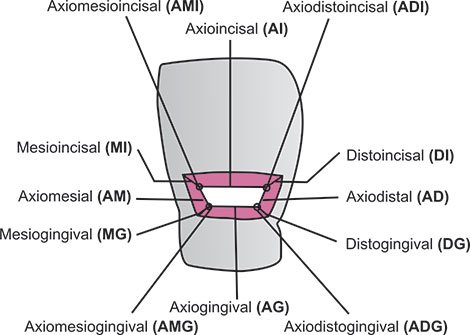  Illustration des angles dièdres et trièdres à l'intérieur d'une préparation cavitaire.