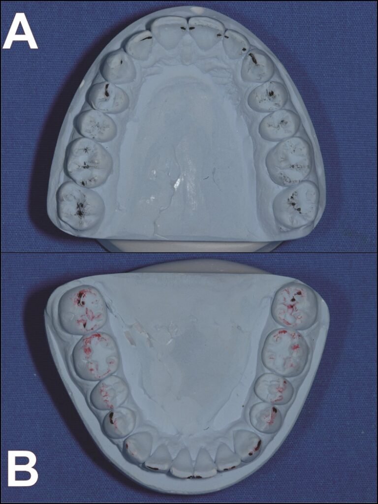 occlusal contacts complete denture intercuspation papier articuler
