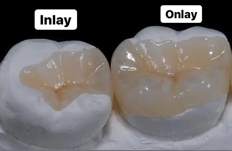 ceramic inlay lithium disilicate posterior tooth