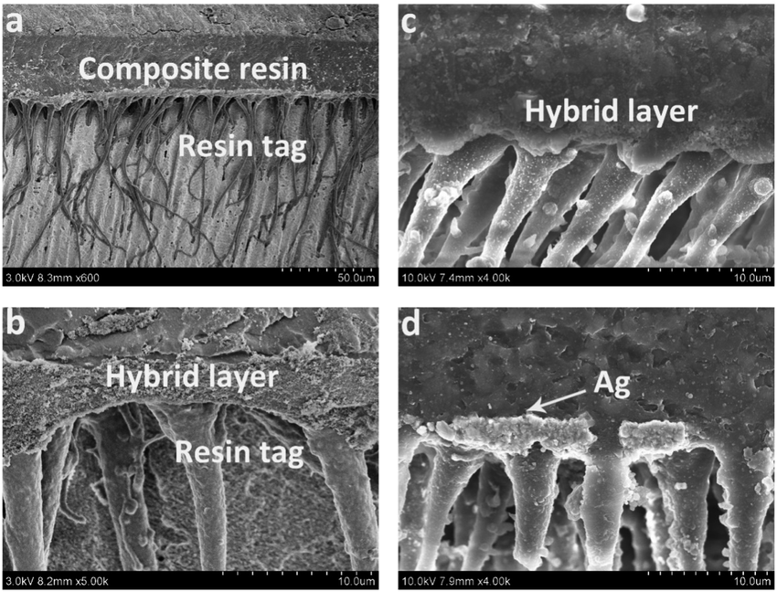 hybrid layer dentin bonding SEM resin tags