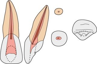 incisor pulp chamber cornes pulpaires anatomy cross section