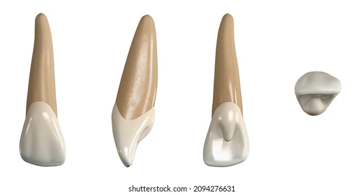  upper lateral incisor palatal pit blind foramen anatomy
