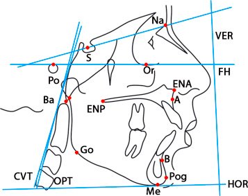  céphalométrie ou schéma montrant la rotation mandibulaire postérieure et l'excès vertical