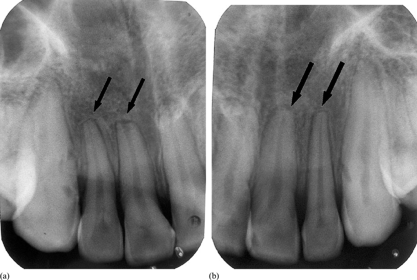four incisors comparison dental anatomy schematic drawing