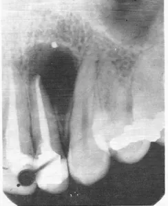 Radiographie d'un kyste radiculaire périapical