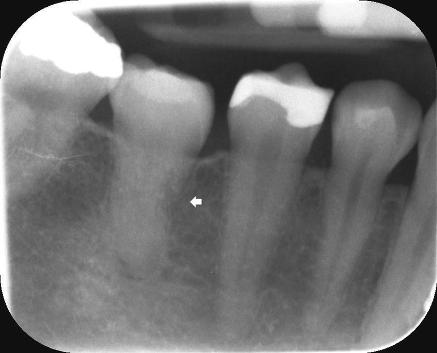 Radiographie d'ankylose dentaire (absence espace desmodontal)