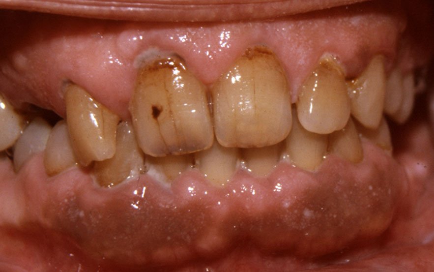  mélanose tabagique (pigmentation diffuse gingivale)