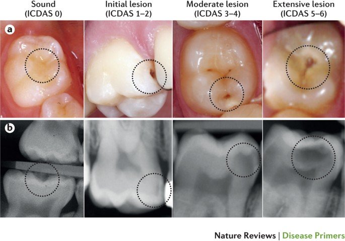 dental caries active inactive lesion comparison