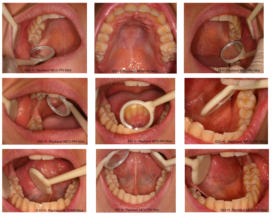 examen endobuccal en cours (praticien avec miroir, abaisse-langue)