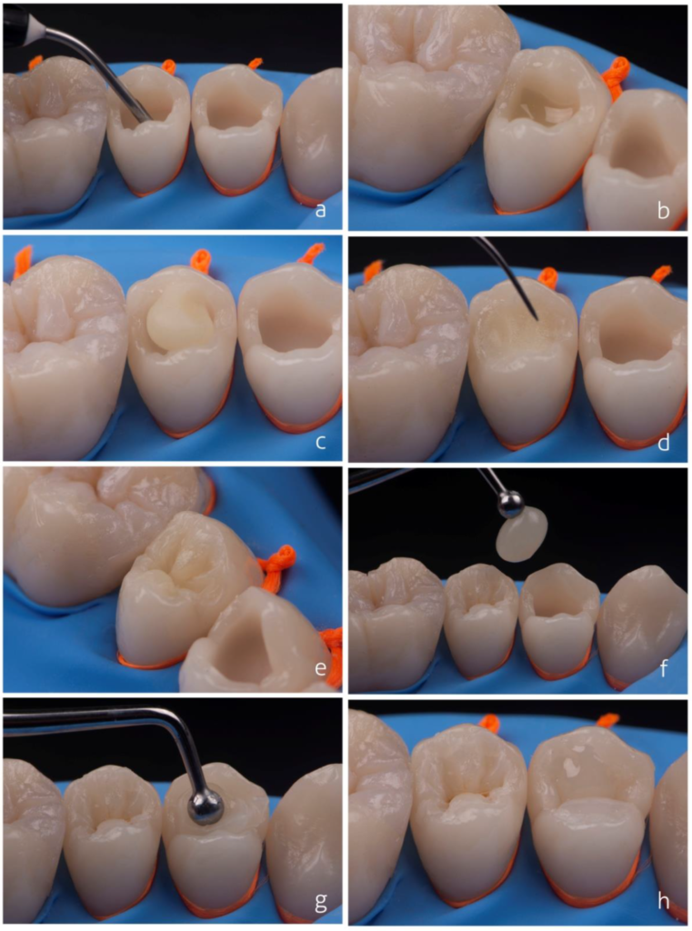 dental composite restoration posterior tooth step by step