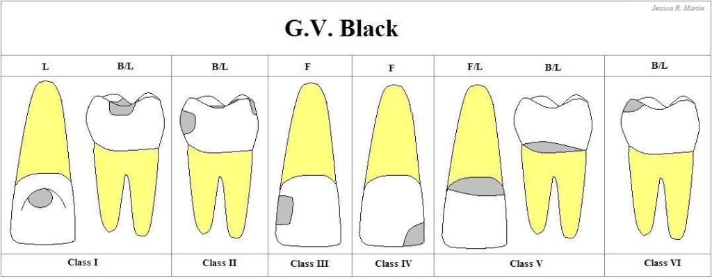Black classification dental caries diagram teeth