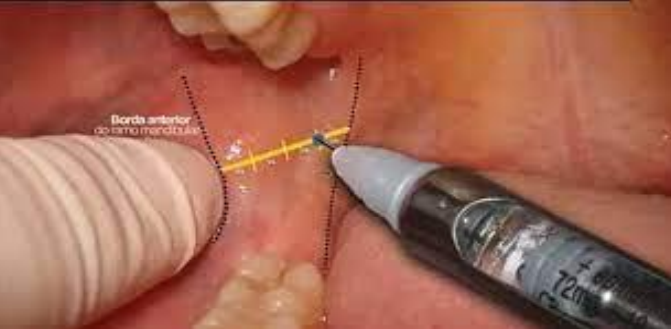 Anesthésie en odontostomatologie : TECHUNIQUES D’ANESTHESIE