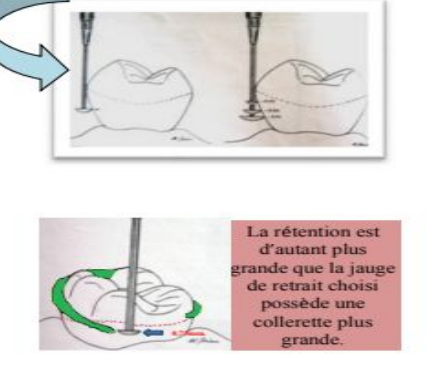 PARALLÉLISME ET AXE D'INSERTION EN PPMA (Prothèse Dentaire)