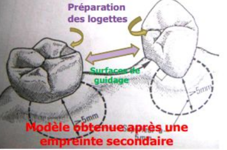 PARALLÉLISME ET AXE D'INSERTION EN PPMA (Prothèse Dentaire)