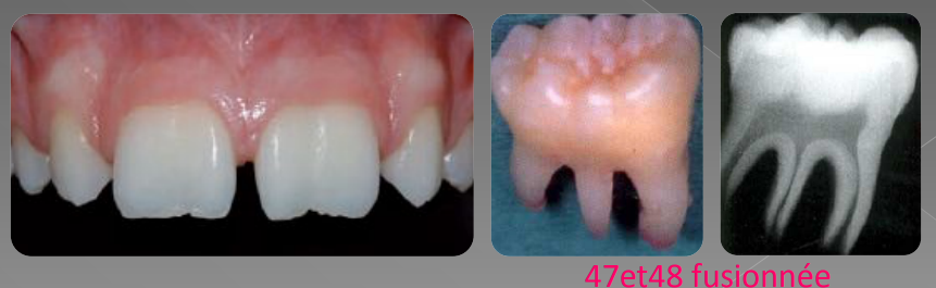 Variations morphologiques de forme des dents permanentes (Odontologie Conservatrice et Endodontie)
