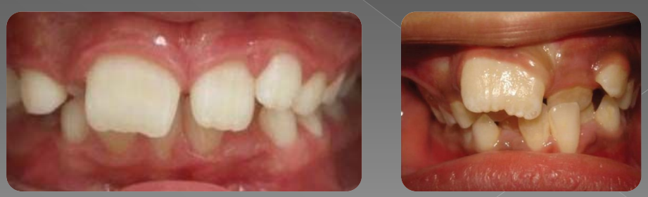 Variations morphologiques de forme des dents permanentes (Odontologie Conservatrice et Endodontie)