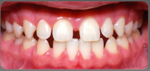 Variations morphologiques de forme des dents permanentes (Odontologie Conservatrice et Endodontie)