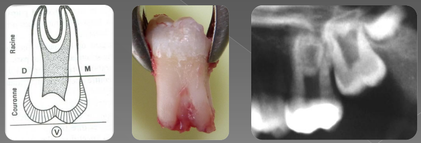 Variations morphologiques de forme des dents permanentes (Odontologie Conservatrice et Endodontie)