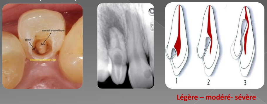 Variations morphologiques de forme des dents permanentes (Odontologie Conservatrice et Endodontie)
