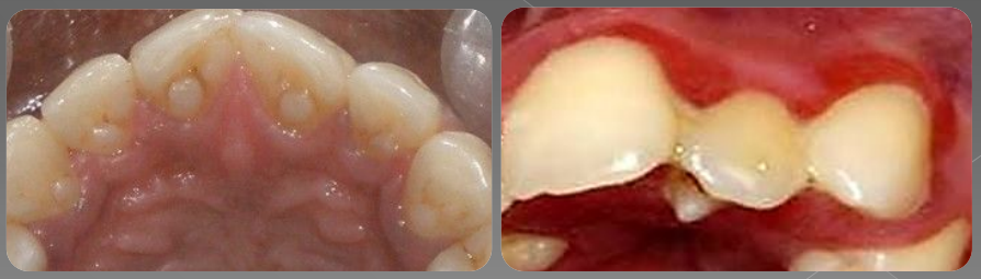 Variations morphologiques de forme des dents permanentes (Odontologie Conservatrice et Endodontie)