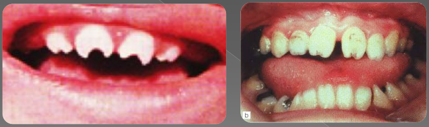 Variations morphologiques de forme des dents permanentes (Odontologie Conservatrice et Endodontie)