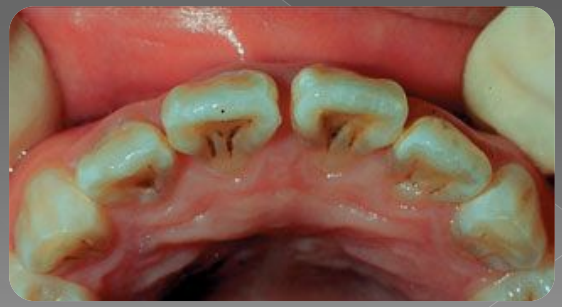 Variations morphologiques de forme des dents permanentes (Odontologie Conservatrice et Endodontie)
