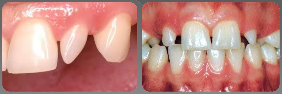 Variations morphologiques de forme des dents permanentes (Odontologie Conservatrice et Endodontie)