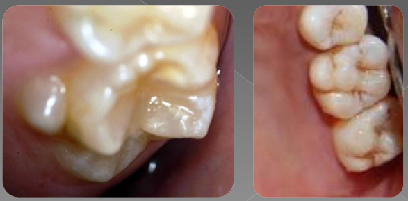Variations morphologiques de forme des dents permanentes (Odontologie Conservatrice et Endodontie)