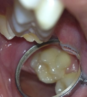 Variations morphologiques de forme des dents permanentes (Odontologie Conservatrice et Endodontie)