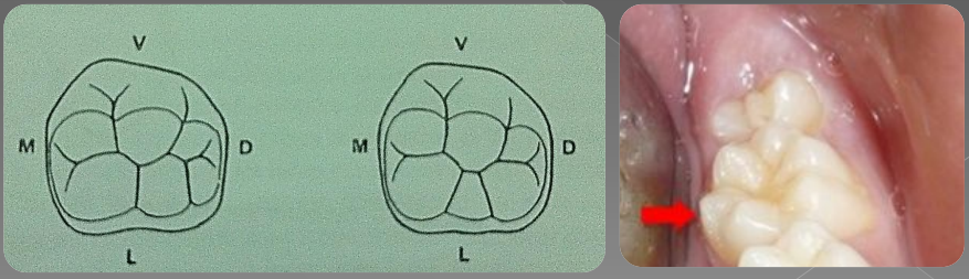 Variations morphologiques de forme des dents permanentes (Odontologie Conservatrice et Endodontie)