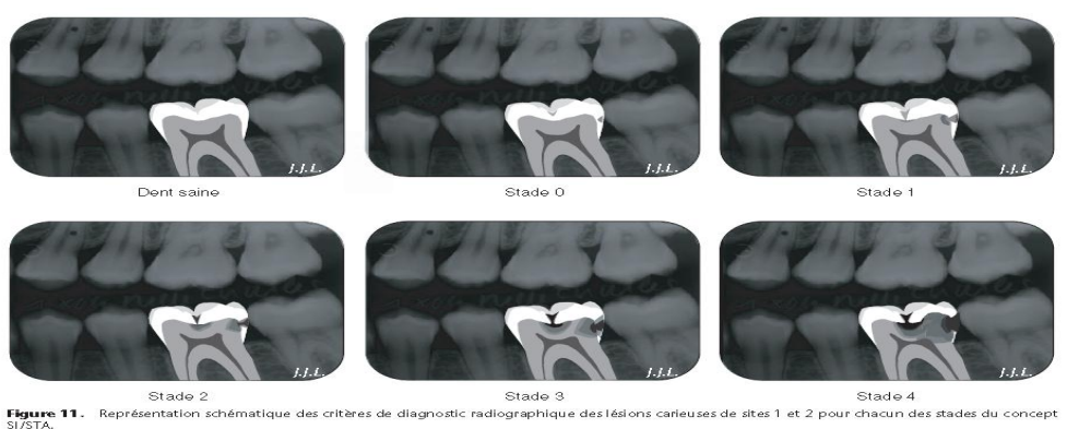 Dentisterie à minima et concepts thérapeutiques – odontologie conservatrice et endodontie
