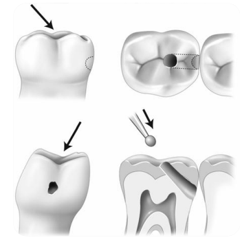Dentisterie à minima et concepts thérapeutiques – odontologie conservatrice et endodontie