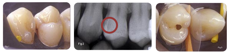 Dentisterie à minima et concepts thérapeutiques – odontologie conservatrice et endodontie