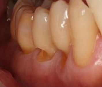 Lésions des Tissus Durs de la Dent d'Origine Autre qu'Infectieuse et Traumatique